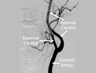 Angiography