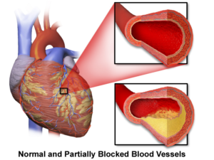 Coronary Artery Disease