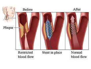 angioplasty