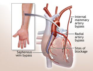 arterybypass